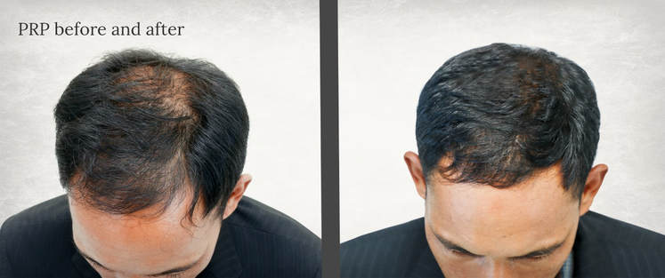 PRP and PRFM in Hair Loss Treatment - MAIPS - Medical Aesthetics  Information Platform and Solutions