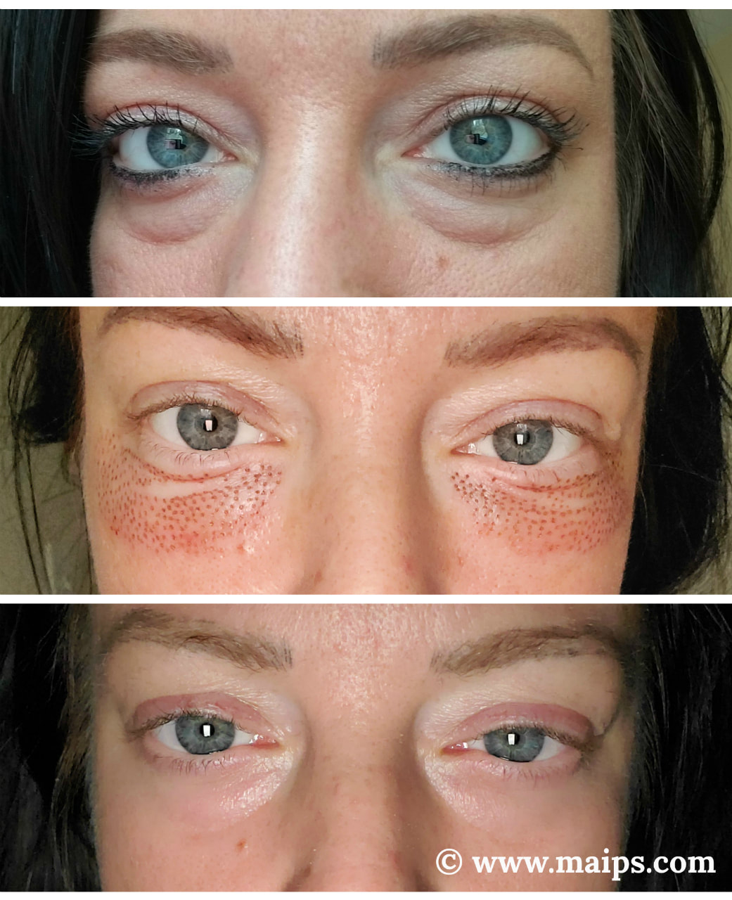 Fibroblast Plasma Skin Lifting lower eyelid before and after 